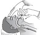 - Αφού τοποθετηθεί σωστά, η συσκευή πρέπει να στερεωθεί με ασφάλεια με ταινία στο πρόσωπο του ασθενή για να αποτραπεί η κίνησή της κατά τη διάρκεια της χρήσης και η απώλεια του αεραγωγού του ασθενή.