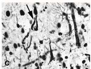 Οι νευροϊνιδιακές αλλοιώσεις περιέχουν ζεύγη ελικοειδών και ευθέων ινιδίων που σχηματίζονται από δυσδιάλυτες υπερφωσφορυλιωμένες