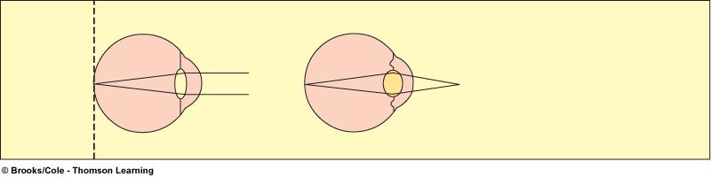 Υπερμετρωπία Μυωπία Όραση Far source Near source Normal eye (Emmetropia) Far source focused on retina without accommodation Near source focused on retina with accommodation