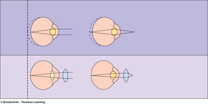 Corrected with concave lens, Eyeball too short or lens too weak which diverges light rays before 1.