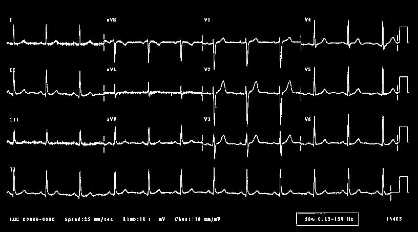 Σήματα 3 - βιοϊατρικά ECG /EKG Τυπικό