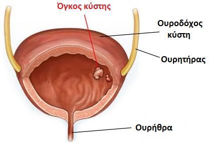 Ο καρκίνος της ουροδόχου κύστεως είναι ο καρκίνος του τοιχώματος της κύστης 2 η πιο συχνή νεοπλασία του