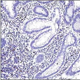 Representative hypermutant Lynch syndrome polyp