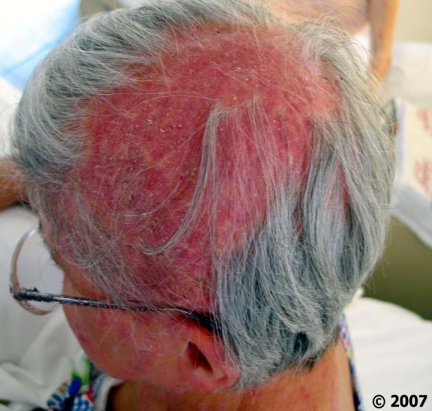 Μόνιμη καταστροφή των μαλλιών με συνέπεια μη-αντιστρεπτή και μη-θεραπεύσιμη αλωπεκία, προκαλούμενη από χρόνια δερματοφυτική λοίμωξη. Η ασθενής δεν είχε αναζητήσει θεραπεία για 50 έτη.