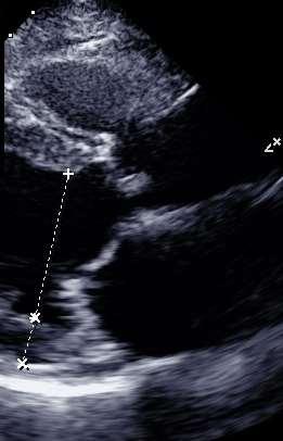 cm (2,6 cm/m 2 )