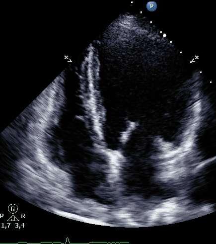 EDV 171 ml 100