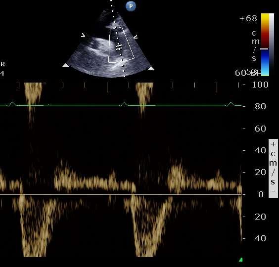 Ascendentna aorta