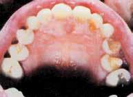 Η μετάβαση από το κέρωμα και τον οδηγό χαμόγελου είναι επακριβής. Η νέα μορφολογία του άνω οδοντικού τόξου είναι ισορροπημένη (Εικ. 8).