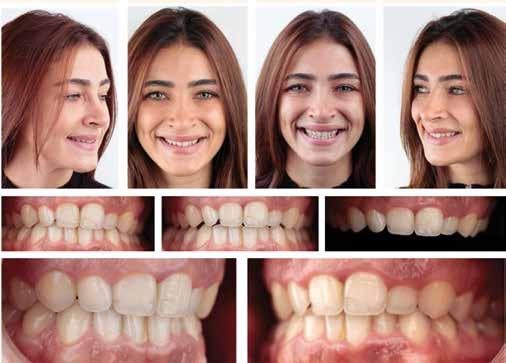Επανορθωτική Οδοντιατρική 46 Dental Tribune Greek Edition Σχεδιασμός χαμόγελου για ελάχιστα επεμβατική θεραπεία Cagdaw Kislaoglu, Turkey Ζούμε στην εποχή όπου οι ασθενείς είναι πολύ συγκεκριμένοι για