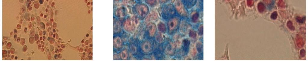 IgA בחלוף כעשור, הודגמה נוכחות של protein AA like material בדגימות כליה של חולי (9). Primary and Myeloma associated Amyloidosis במחקר אחר מאותה תקופה הודגם כי SAA קיים כ- Apolipoprotein של HDL בחולי.