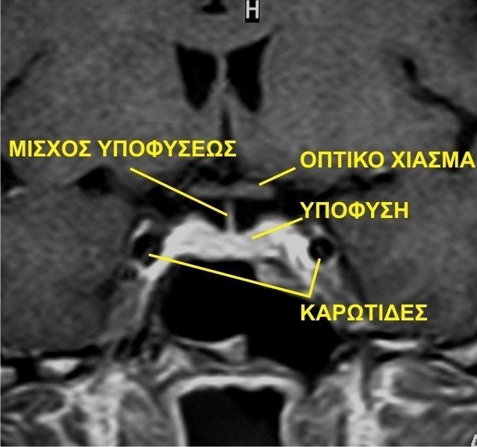 Ανατομία της υπόφυσης (2) Σε γυναίκες μετά από πολλές εγκυμοσύνες και τοκετούς η υπόφυση έχει λίγο μεγαλύτερο βάρος (ύψος 10-12 mm απο 6-8mm)από χωρίς κύηση ή από τους άντρες.