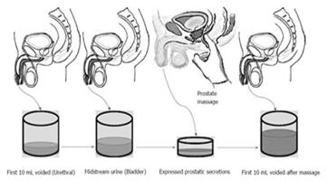 Pain symptoms Perineum Suprapubic region Testicles, penis (especially penile tip pain) Lower back, abdomen Inguinal region/groin Rectum Urinary symptoms Voiding LUTS (weak stream, straining and