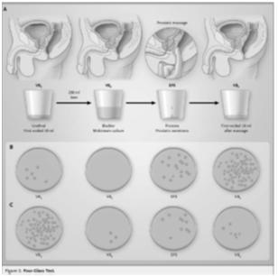 after, ejaculation) Decreased libido Psychosocial symptoms Anxiety or stress Depression Cognitive/behavioural consequences Decreased QoL Pain on urination, or that increases with urination Pain