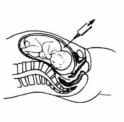 Amniocentesis