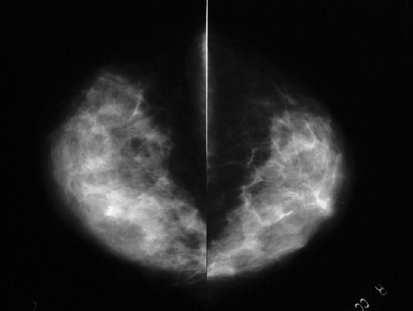 CANCRO E HERDANZA O cancro é unha enfermidade xenética porque se