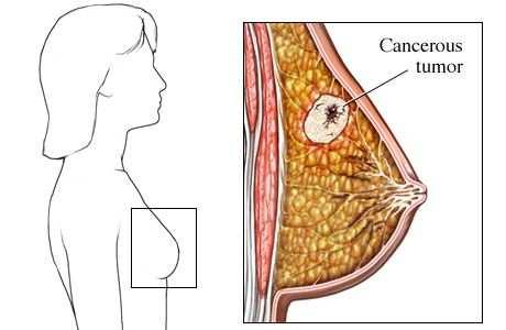 É dicir, que salvo unha pequena porcentaxe, o cancro non se transmite