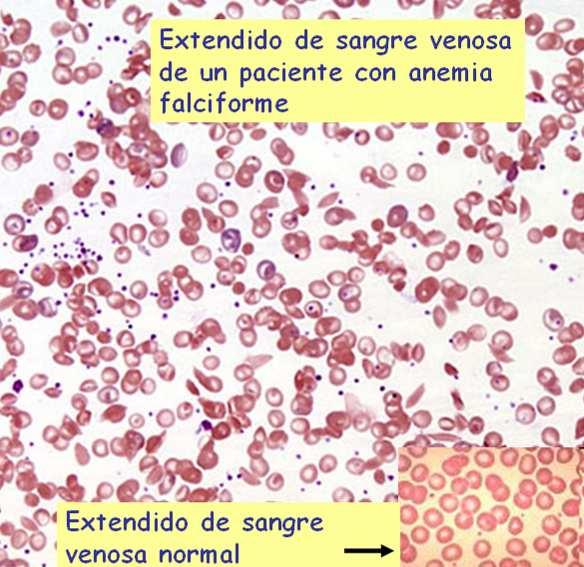 Un caso de mutación n xénicax nica: a anemia