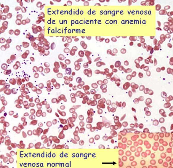 Un caso de mutación n xénicax nica: a anemia