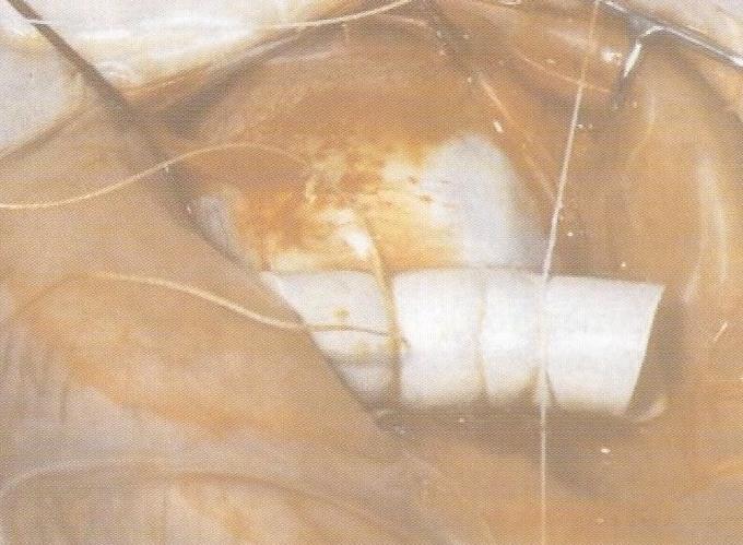 Συχνά, ως θεραπευτική μέθοδος χρησιμοποιείται αυτή των μοσχευμάτων στο σκληρό χιτώνα.