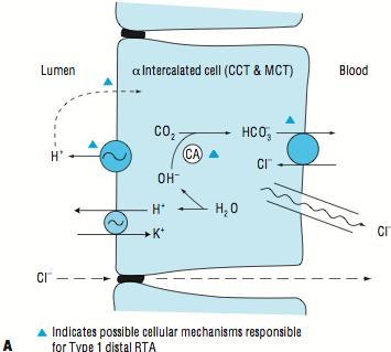 ACIDOZE METABOLICE HIPERCLOREMICE ACIDOZELE TUBULARE RENALE TIP I clasificare ART primară, apare în special la femei: mutație a schimbătorului Cl /HCO 3 din membrana bazală.