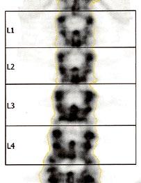 Mugurkaula jostas skriemeļu KMB noteikšana Jostas skriemeļi L 1 L 4 posterior-anterior (PA) pozīcijā; KMB nosaka visos mugurkaula jostas daļas skriemeļos, kurus ir iespējams novērtēt, iz slēdzot