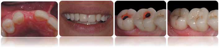 Εμφυτεύματα 56 Dental Tribune Greek Edition DT σελίδα 54 σημαντική(εικ. 8a&b).