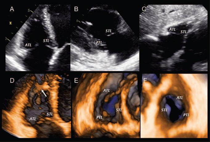 Comprehensive assessment of the morphology of the valvulo- ventricular complex