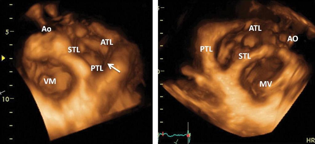 Normal tricuspid valve leaflets visualized by real-time threedimensional