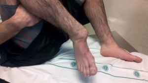 Κλινική εικόνα Το πόδι βρίσκεται σε πελματιαία κάμψη & σχεδόν