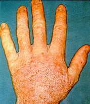 Peronospora
