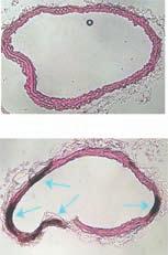 Serum creatinine (µg/dl) Calcified lesion (%) Serum stearate (mg/ml) A B C D 3 1 15 1 5 Sham CKD Serum phosphorus (mg/dl) Aortic Calcium (µg/mg) 1 1 1 8 6 18 16 1 1 1 8 6 1. Scd mrna level (vs.