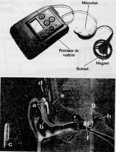B. SISTEME DE PERCEPTIE SONORA - La inceputuri tuburi si cornete - 1900 microfoane; 1950 cu tranzistori; in prezent implantul cohlear Exemple: 1. Proteza auditiva clasica (fig.