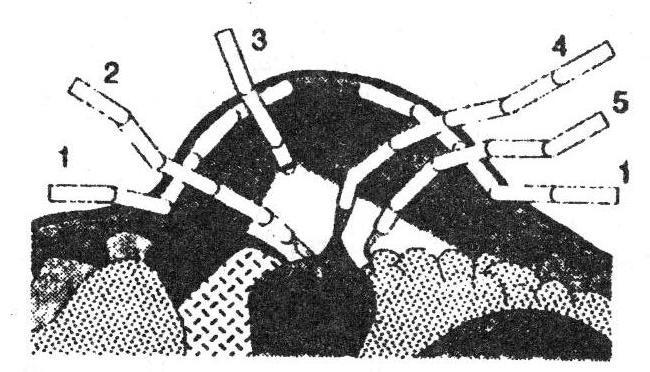 Fig. 12 - Echipament pt mentinerea posturii bipede si asistarea mersului C.