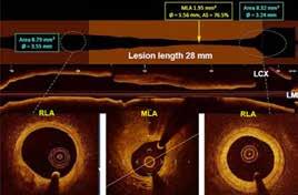 πιθανώς 21% ΕΙΚΟΝΑ 7. Μέτρηση ελάχιστης επιφάνειας του αυλού του αγγείου (MLA), επιφάνειας του αυλού στα υγιή τμήματα εκατέρωθεν της βλάβης (RLA) και του μήκους της βλάβης (lesion length).