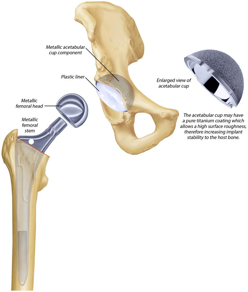 Total Hip Joint Replacement Expanded View 3.