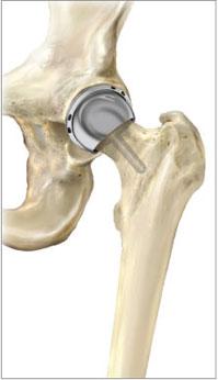 Alternative to total Hip Replacement Total hip resurfacing arthroplasty: A bone-preserving procedure that helps restore comfort and function to patients hips damaged by