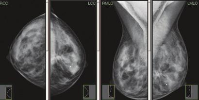 האגודה למלחמה בסרטן בישראל )ע"ר( אונקולוגיה מהנשים, שאינן יכולות לעבור בדיקת.MRI 6. שיפור ביכולת להחליט מאילו ממצאים צריך לבצע ביופסיה.