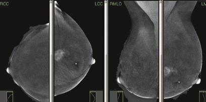 בדומה לבדיקת ה MRI וכתוצאה מהזרקת חומר הניגוד, מתקבל שילוב של הדמיה אנטומית מורפולוגית והדמיה תפקודית המדגימה אנגיוגנזיס בגושים שהתגלו בשד.