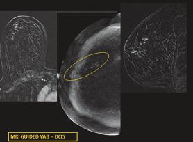 בשורה התחתונה, תמונת הממוגרפיה לאחר הזרקת חומר ניגוד, תמונת ההחסרה, שד ימין ללא ממצא, שד שמאל גוש יחיד מרכזי, שנמצא בביופסיה, כקרצינומה של השד. תמונה מס.