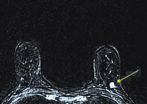 הרדיולוג מעריך את צפיפות רקמת השד בהתאם ללקסיקון של הקולג האמריקאי לרדיולוגיה (ACR- American College of,(radiology בו נקבע סולם בן ארבע דרגות הקרוי BI-RAD.