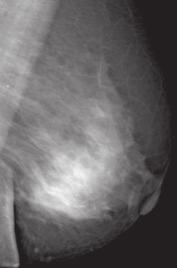 במחקר שנערך על ידי Berg ושותפיה ]21[, נמצא שבדיקת MRI שדיים, בנוסף לבדיקות הסקר האחרות ממוגרפיה ואולטרסאונד, יעילה למדי לנשים בסיכון גבוה עם שד צפוף: היא יכולה לגלות עוד 14.