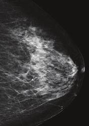 במה ביטאון לעובדי בריאות בנושא מחלת הסרטן והשלכותיה מיפוי איזוטופי של השד במיפוי איזוטופי של השד נעשה שימוש בשתי שיטות: Positron Emission Mammography - PEM.1 Breast Specific Gamma Imaging - BSGI.