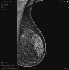 )Carcinoma in Situ עם זאת, במקרים של שד צפוף, כאשר יכולת בדיקת הממוגרפיה לגלות גושים נמוכה, יש צורך בבדיקות דימות נוספות לצרכי אבחון. במרבית המקרים תמונה מס.