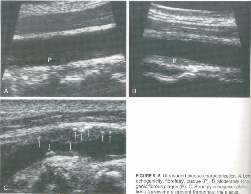 PLAQUE 5808 asymptomatic adults, FU 3 years.