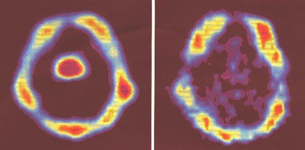 AORTA, 18 FDG