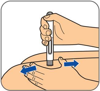 B. Βήματα πραγματοποίησης της ένεσης Βήμα 1: Πλύνετε τα χέρια σας με σαπούνι και νερό. Βήμα 2: Σκουπίστε με το τολύπιο με οινόπνευμα το σημείο που θα γίνει η ένεση.