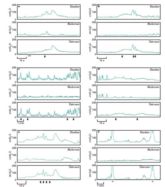 42 ασθενείς (36 αγόρια) με ΚΟΠ (III,IV) και 21 χωρίς (16 αγόρια) Έλεγχος της λειτουργίας της κύστης Διάφορα patterns (φυσιολογικό, ανώριμο, ασταθές, ανεπαρκές, αποφρακτικό) Φυσιολογικά παιδιά: