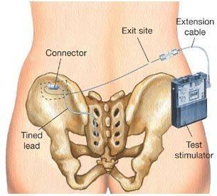 Τranscutaneous Εlectrical Νerve Stimulation Δεν είναι δυνατή η εμφάνιση της εικόνας.