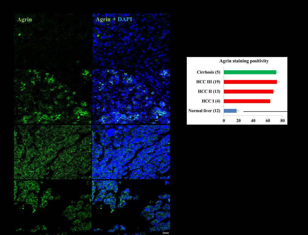 Supplementary Figure 16: Expression of Agrin in normal liver and HCC patient tissues.