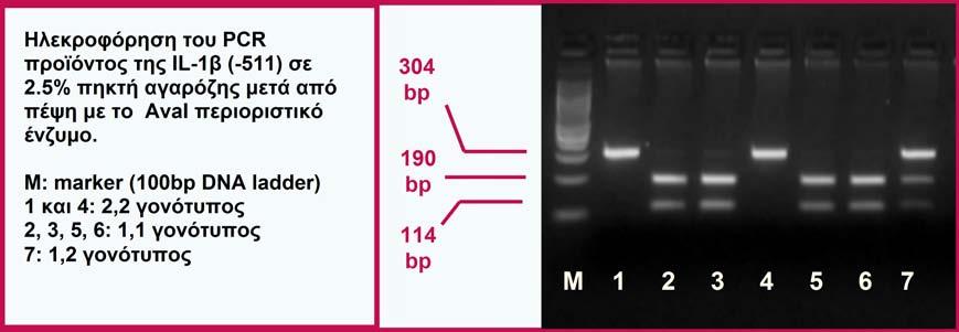 Ηλεκροφόρηση του PCR προϊόντος της IL-1β (-511) σε 2.5% πηκτή αγαρόζης μετά από πέψη με το AvaI περιοριστικό ένζυμο.